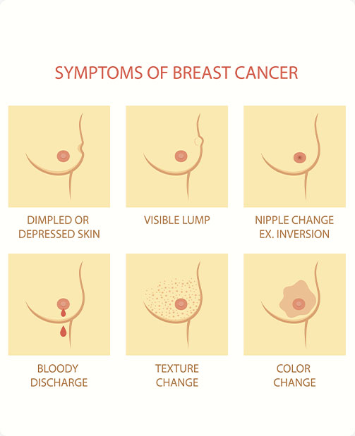 Symptoms Of Breast Cancer